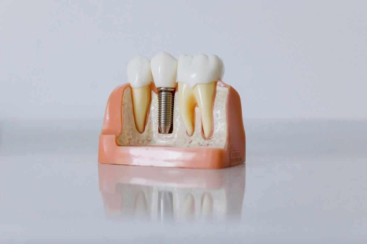 Dental Veneers For Missing Teeth